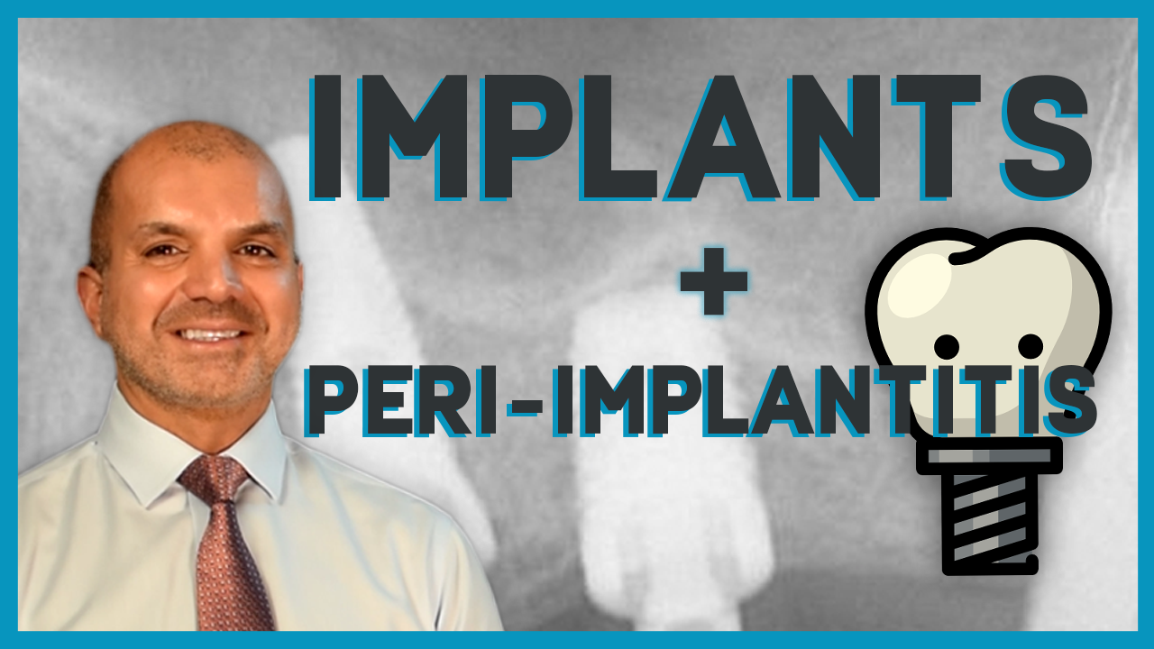 Implantd